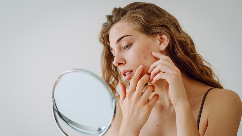 acne akmi shutterstock 2476357525 jpg