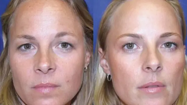 botox panomoiotypes didymes 1 webp webp