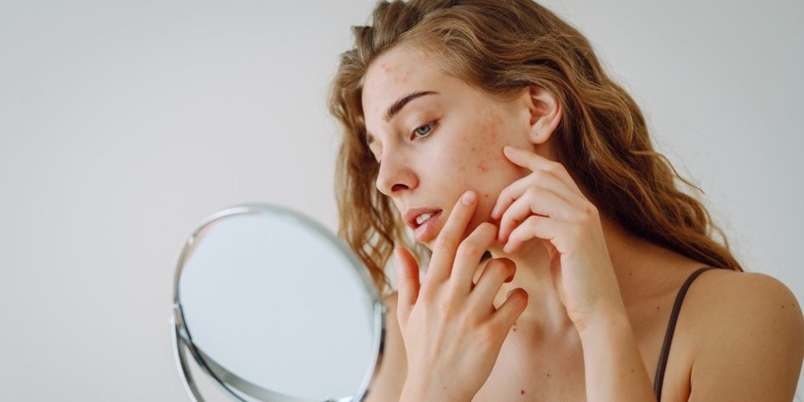 acne akmi shutterstock 2476357525 jpg