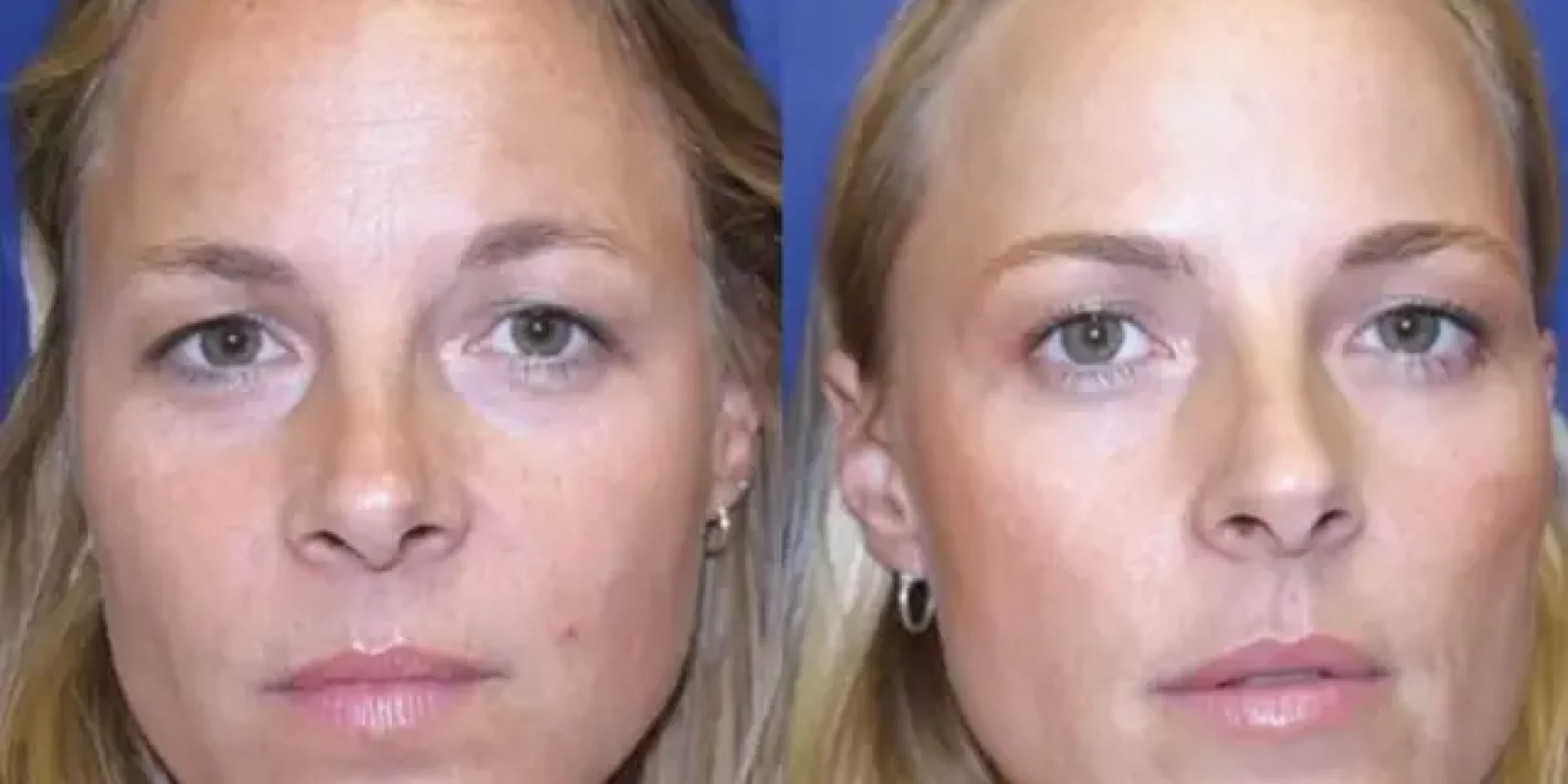 botox panomoiotypes didymes 1 webp webp