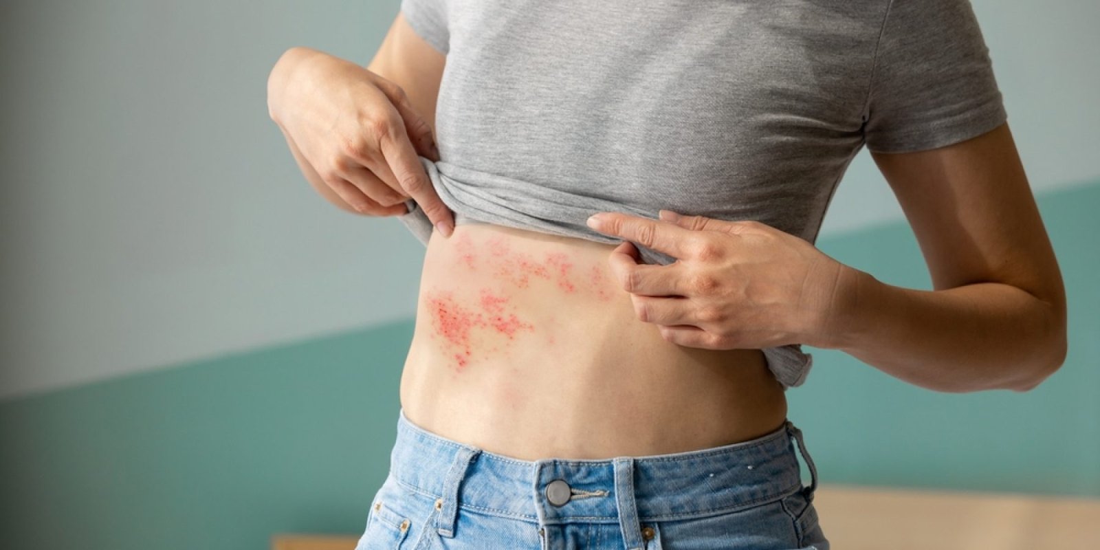 erpis herpes shutterstock 2289955165 jpg
