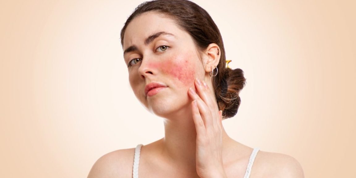 girl skin rash lupus 1768127561 jpg