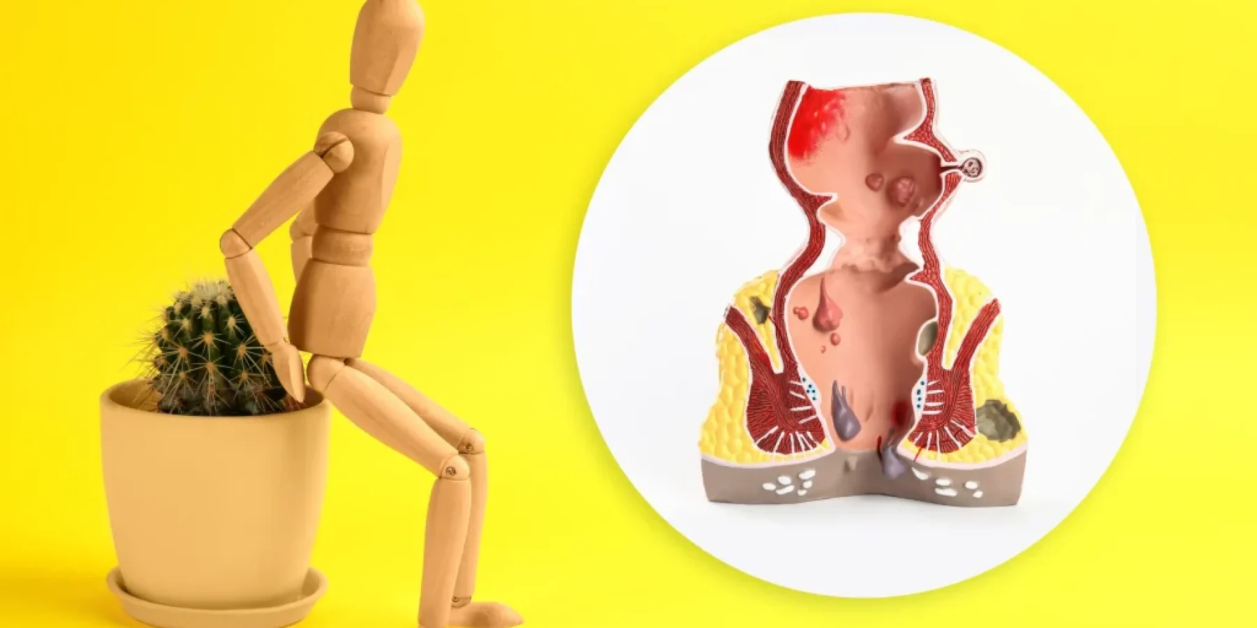 Φυσικοί Τρόποι Αντιμετώπισης Αιμορροΐδων Συμβουλές για Το Σπίτι.webp