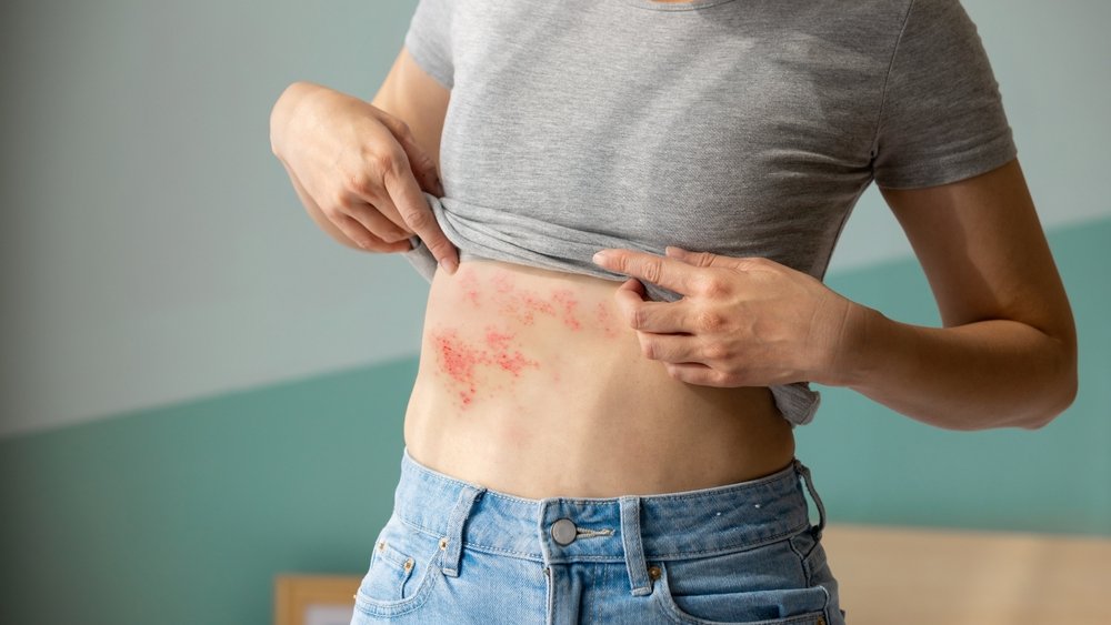 erpis herpes shutterstock 2289955165 jpg